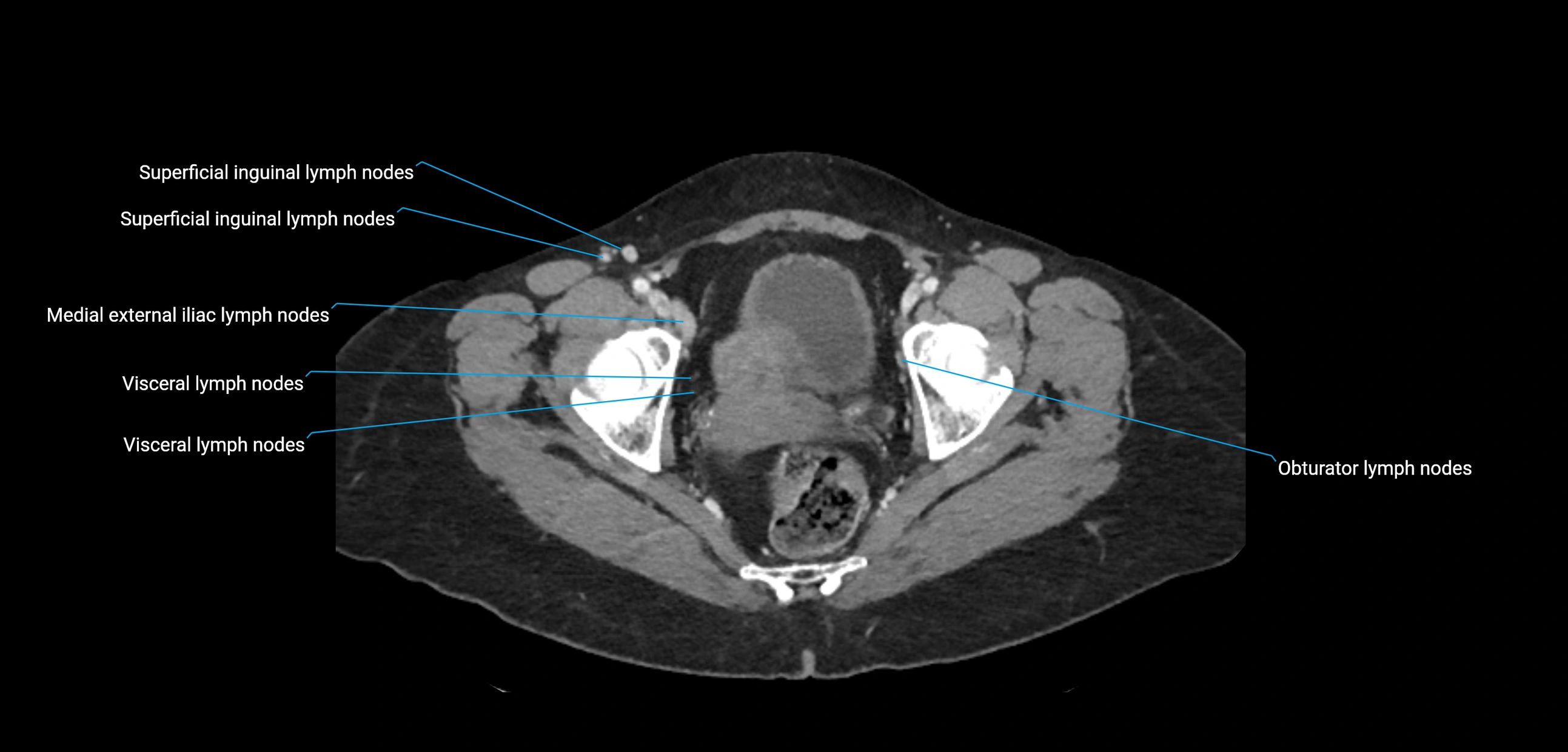 CT ct abdominal lymph nodes  axial cross sectional anatomy  enchanced radiology image -img-00002-00379.webp